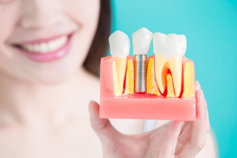 como limpiar implantes dentales
